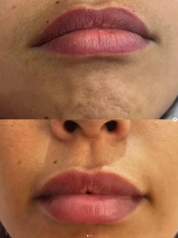 Resultado Preenchimento Labial